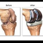 knee_replacement